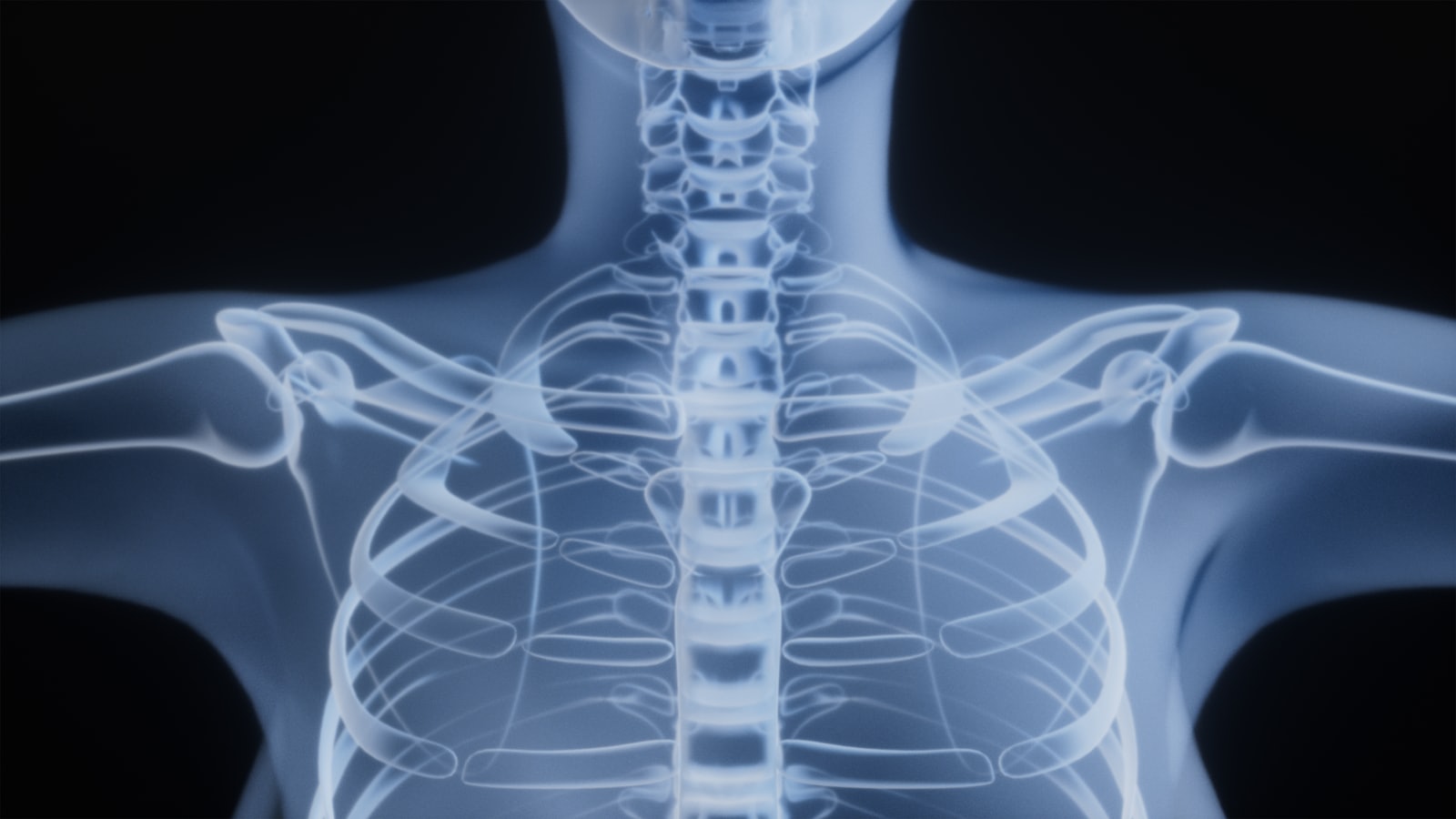 Spinal cord stimulator lawsuit over implanted pain device failures